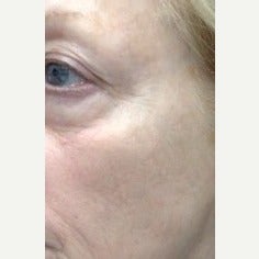 65-74 year old woman treated with Pelleve after 1599204