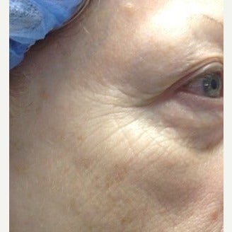 65-74 year old woman treated with Pelleve 1599204