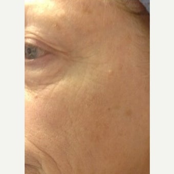 65-74 year old woman treated with Pelleve before 1599204