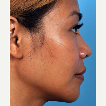 35-44 year old woman treated with Rhinoplasty after 3815661