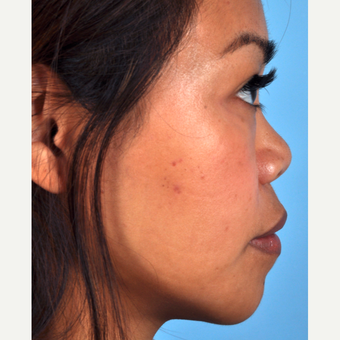 35-44 year old woman treated with Rhinoplasty before 3815661