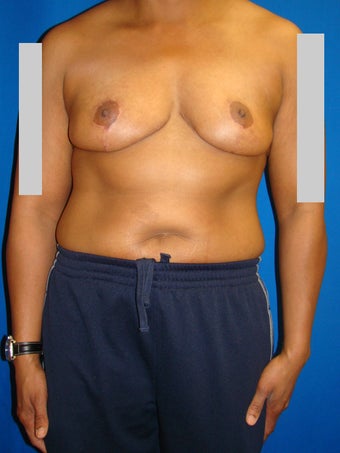 Breast reduction after 78036