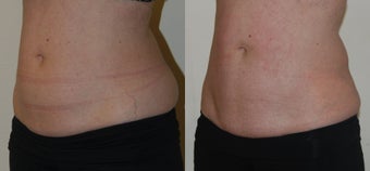 CoolSculpting to abdomen and love handles before 1376633