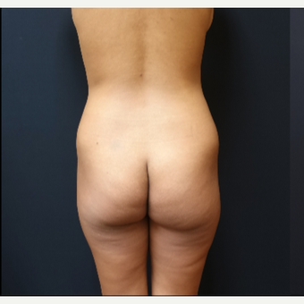 25-34 year old woman treated with Fat Transfer before 3731828