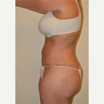 25-34 year old woman treated with Liposuction after 3658470