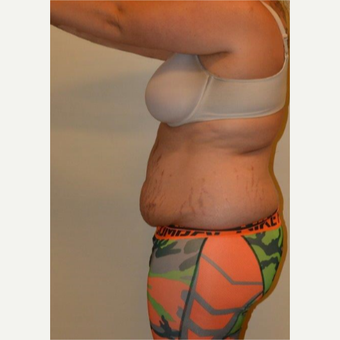 25-34 year old woman treated with Liposuction before 3658470