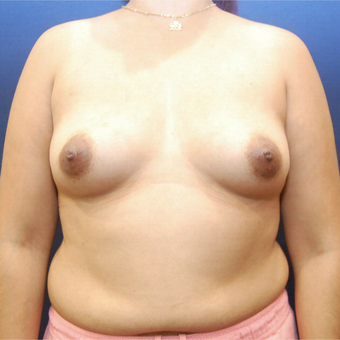 25-34 year old woman treated with Breast Augmentation before 3726749