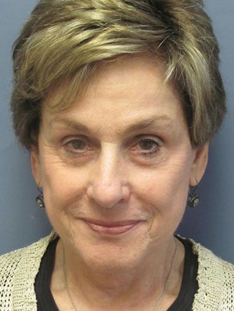 Blue Peel, Chemical Peel after 954431