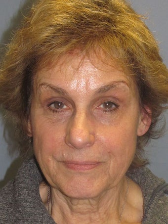 Blue Peel, Chemical Peel before 954431