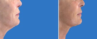 Ultherapy before 1214290