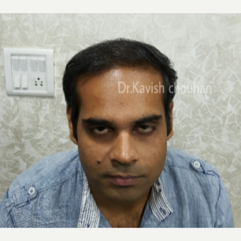 25-34 year old man treated with FUE Hair Transplant after 2836633