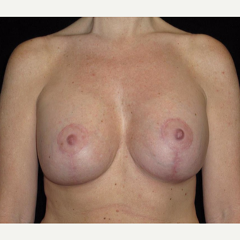 41 year old woman treated with Breast Lift with Implants after 3026061