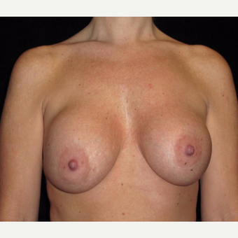 41 year old woman treated with Breast Lift with Implants before 3026061