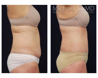 Liposuction before 1323841