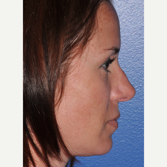 Rhinoplasty for Improved Profile and Nasal Tip after 3702971