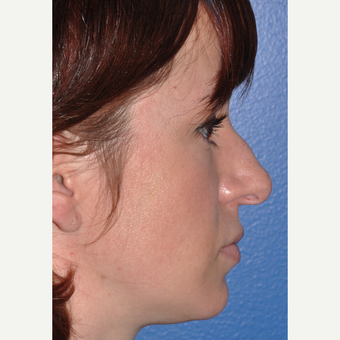 Rhinoplasty for Improved Profile and Nasal Tip before 3702971