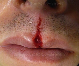Lip scar and incision treatment before 1050523