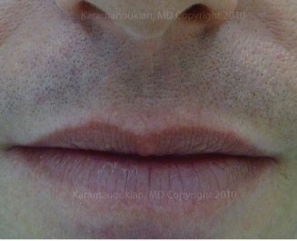Lip scar and incision treatment after 1050523