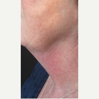 55-64 year old woman treated with Kybella after 3220521