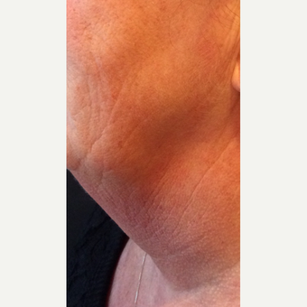 55-64 year old woman treated with Kybella before 3220521