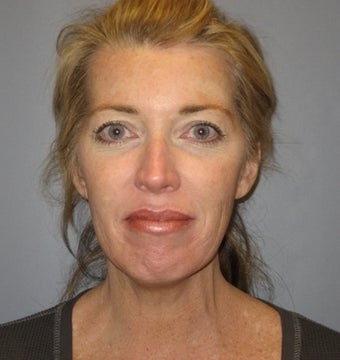 46 Year Old Woman Seeks Younger-looking Appearance before 1475044