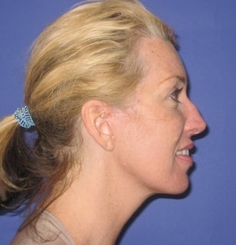 46 Year Old Woman Seeks Younger-looking Appearance 1475044