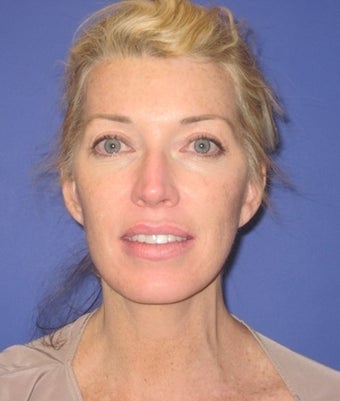 46 Year Old Woman Seeks Younger-looking Appearance after 1475044
