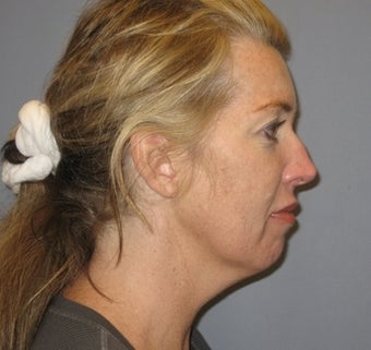 46 Year Old Woman Seeks Younger-looking Appearance 1475044