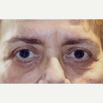 75 and up year old woman treated with Eyelid Surgery after 3083188