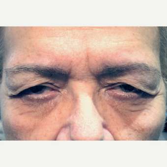 75 and up year old woman treated with Eyelid Surgery before 3083188