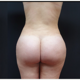 18-24 year old woman treated with Butt Lift after 3315505