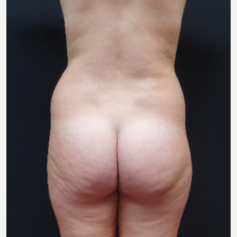 18-24 year old woman treated with Butt Lift before 3315505