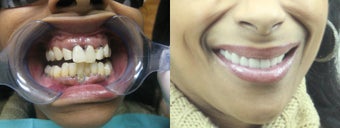 Smile Makeover before 1232794