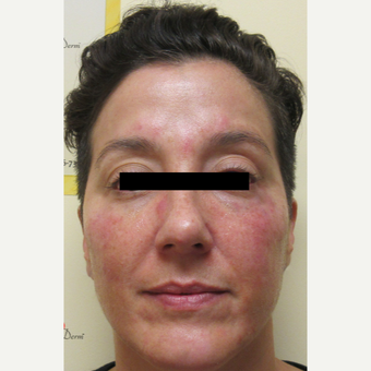 35-44 year old woman treated with Voluma after 3812951