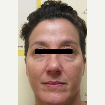 35-44 year old woman treated with Voluma before 3812951
