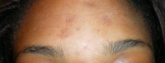 Exfoliating Facial for Pigmented Acne Scars after 110223