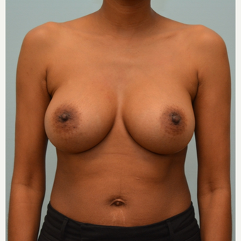 Breast Augmentation With Natrelle 410 Shaped Implants after 3298746