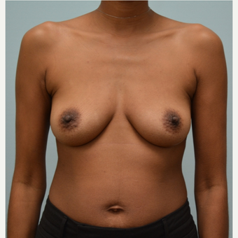 Breast Augmentation With Natrelle 410 Shaped Implants before 3298746