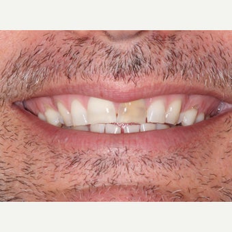 35-44 year old man treated with Porcelain Veneers before 1656695