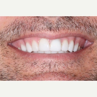 35-44 year old man treated with Porcelain Veneers after 1656695