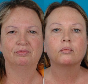 51-year-old woman treated with Botox. before 3265085