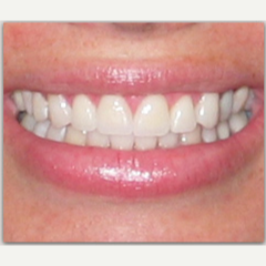 18-24 year old woman treated with Porcelain Veneers after 3428136