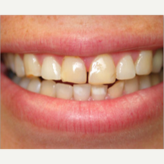 18-24 year old woman treated with Porcelain Veneers before 3428136