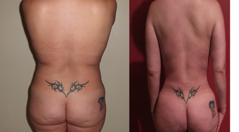 43 Year Old Female with Liposuction and Fat grafting before 972947