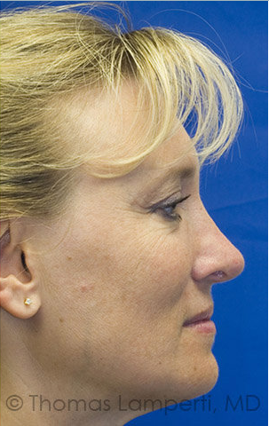 Revision rhinoplasty after 233188