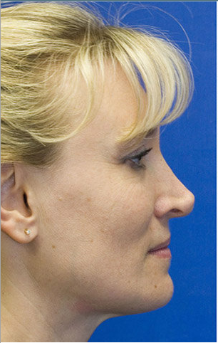 Revision rhinoplasty before 233188