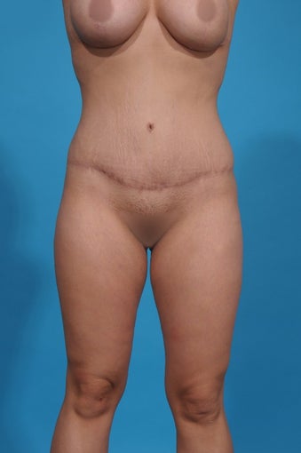 28 year old woman treated with Tummy Tuck after 1700093