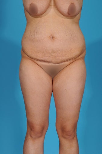 28 year old woman treated with Tummy Tuck before 1700093