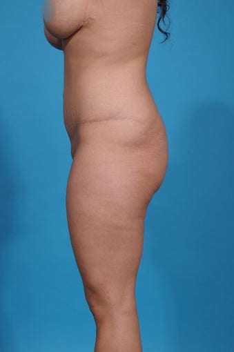 28 year old woman treated with Tummy Tuck 1700093