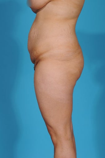 28 year old woman treated with Tummy Tuck 1700093
